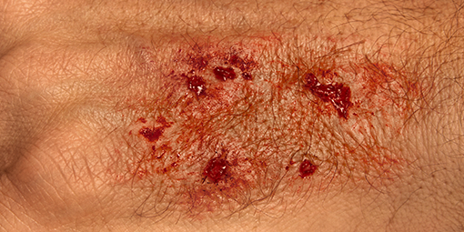 gros plan d’une peau montrant une plaie par pénétration cutanée ou une morsure. gros plan d’une peau montrant une plaie par pénétration cutanée ou une morsure.